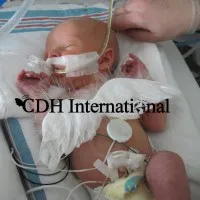 CDH Research International - the World's Congenital Diaphragmatic Hernia Charity