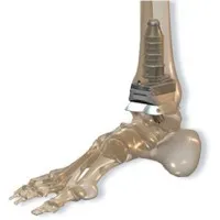 PROTIL PRÓTESE E INSTRUMENTAL LTDA.