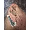 DyAnsys Inc. -auricular neurostimulation
